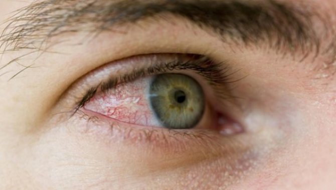 Göz alerjileri bahar aylarında daha yaygın