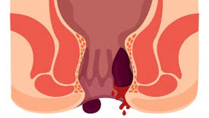 Medipol Üniversitesi Pendik Hastanesinden hemoroid ve anal fissürün ciddiye alınması uyarısı