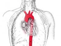 Bu kadar sağlam aort damarı nasıl yırtılır?