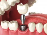 Implant ve Diş Yapısı Hakkında