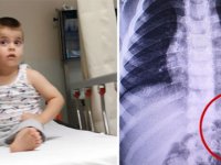 3 yaşındaki Yasin'in yuttuğu çengelli iğne çıkarıldı