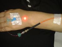 Diyabetik ayakta organ kaybına son veren tedavi: Düşük enerjili laser tedavisi